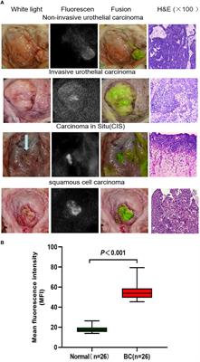 Ex vivo near-infrared targeted imaging of human bladder carcinoma by ICG-anti-CD47